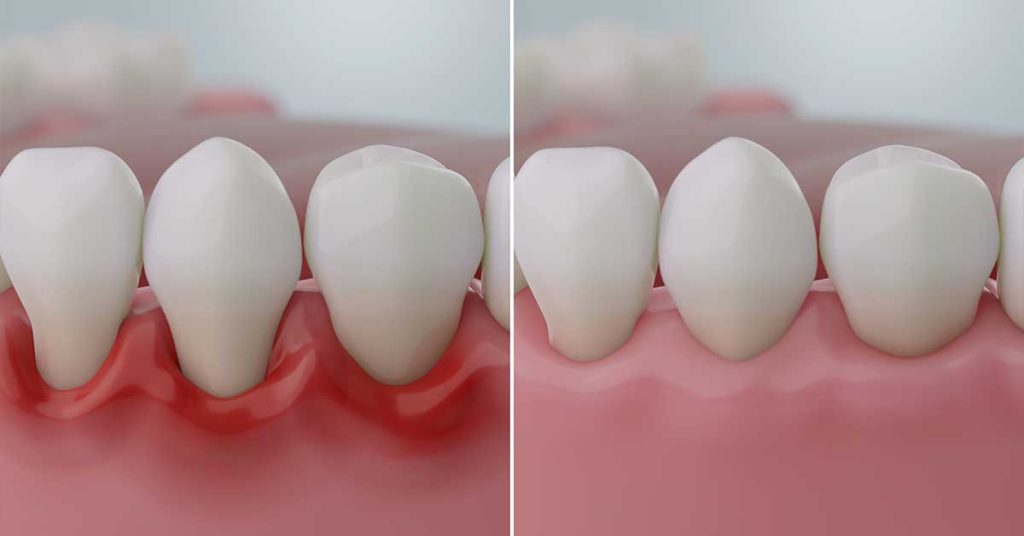 How Can I Prevent Gum Disease