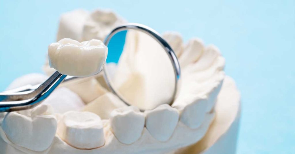 What Is a Dental Crown and When Do You Need One